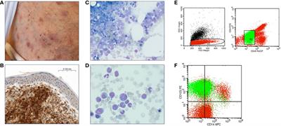 Real-world evidence on tagraxofusp for blastic plasmacytoid dendritic cell neoplasm – collected cases from a single center and case reports